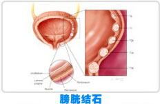 膀胱结石