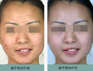 扁平疣治疗前后对比图