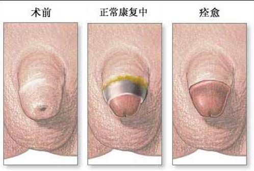 包皮过长图片