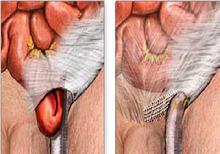 男人前列腺增生有哪些症状
