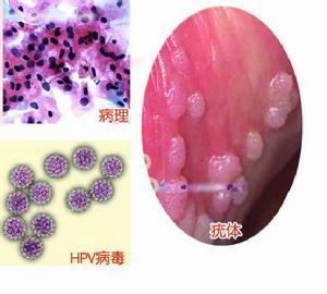 尖锐湿疣是怎么引起的