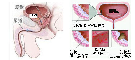 男性膀胱炎日常中如何预防