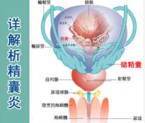 精囊炎的表现症状有哪些