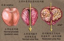 缓解前列腺痛有妙招