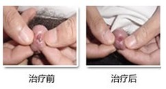 男性尿道炎有什么表现症状