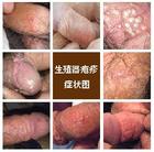 生殖器疱疹的典型症状