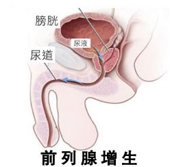 哪些病因诱发前列腺增生