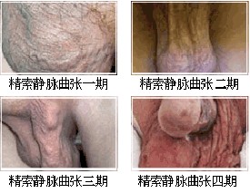 精索静脉需要做哪些检查