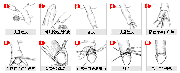 苏州东吴中西医结合医院泌尿科包皮过长