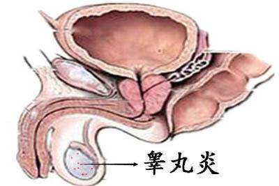 苏州男科医院，导致睾丸炎的原因是什么?