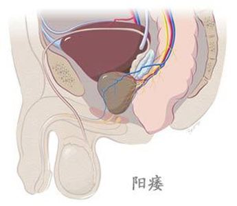 天津蓟州治疗阳痿好的医院，阳痿的症状？