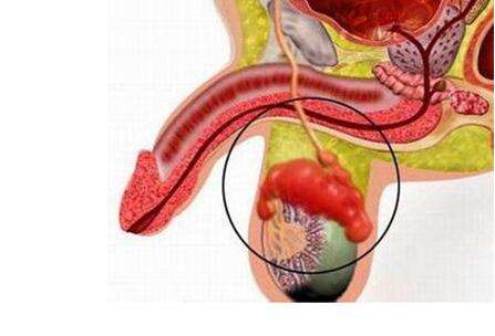 苏州男科医院排，附睾炎有什么症状?