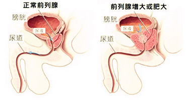 苏州治疗前列腺炎,前列腺对生育的影响？