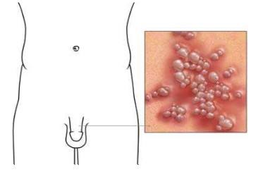苏州性病医院，生殖器疱疹的症状