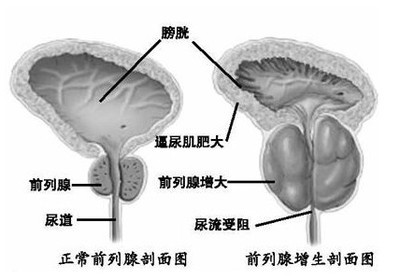 苏州哪家男子医院比较好,前列腺增生的特征？