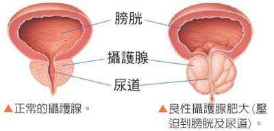 苏州男科医院前列腺肥大检查项目