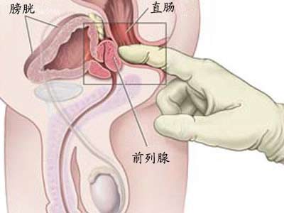 石河子男科医院，前列腺炎会引起早泄吗?