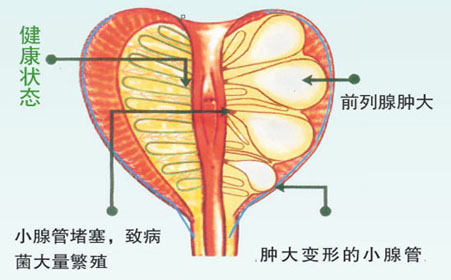 苏州治疗前列腺炎医院