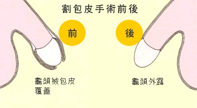 【苏州男科医院】男性包茎存在的健康隐患有哪些