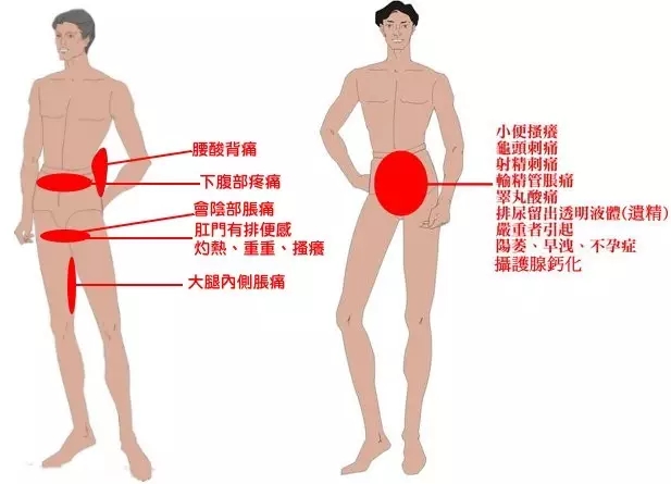 石河子男性前列腺炎常见症状？
