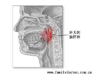 腺样体肥大的诊断检查