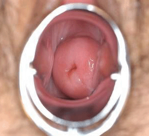 宫颈息肉 宫颈息肉图片