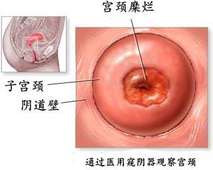 宫颈糜烂 宫颈糜烂的图片