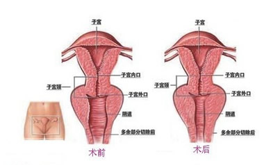 阴道紧缩术注意事项