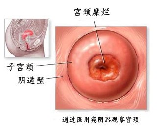 宫颈糜烂检查