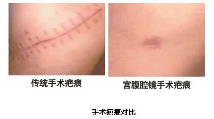 子宫肌瘤的治疗方法