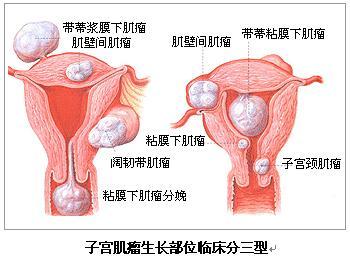 子宫肌瘤的微创手术治疗