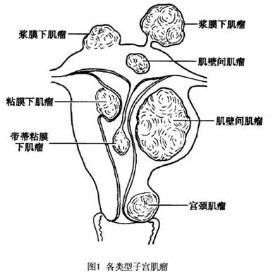 苏州治疗子宫肌瘤较好的方法