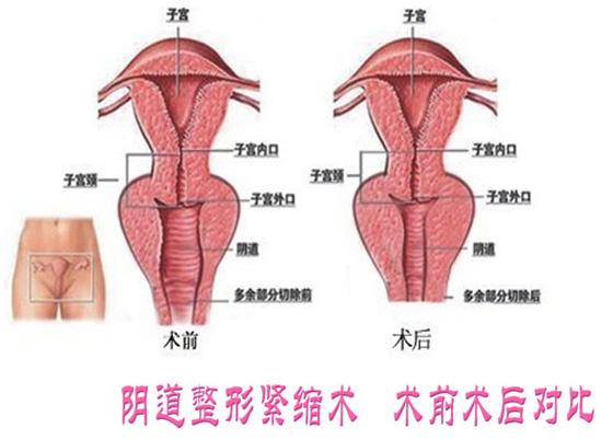 苏州阴道紧缩术全过程