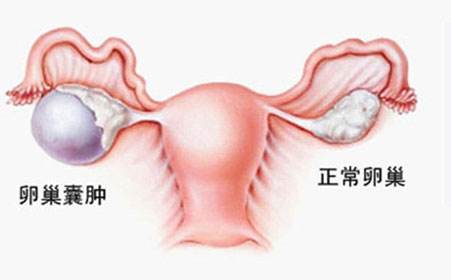 苏州较好的妇科医院_卵巢肿瘤术后如何护理