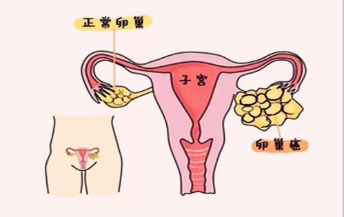 苏州卵巢囊肿的妇科医院_卵巢良性肿瘤的早期症状