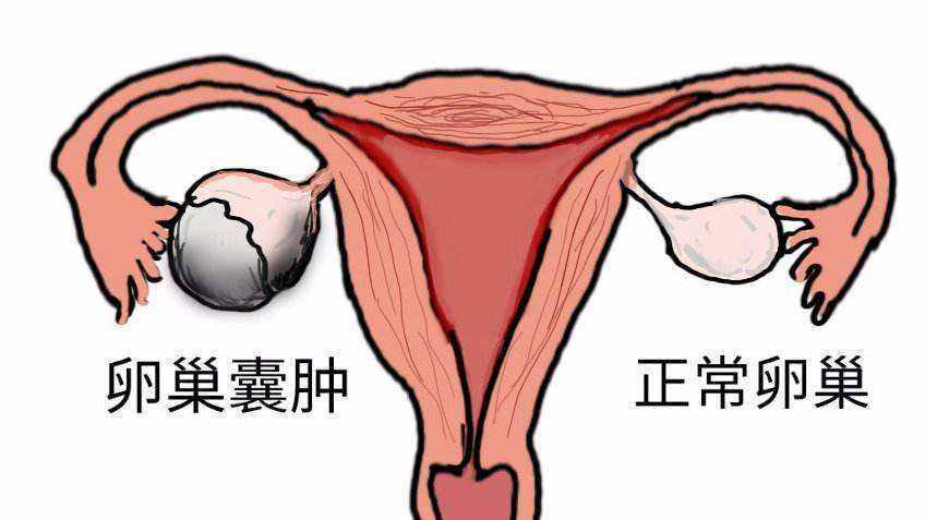 苏州卵巢囊肿妇科医院_卵巢囊肿有哪些症状