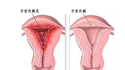 苏州看妇科正规的医院_子宫内膜炎的诱因有哪些