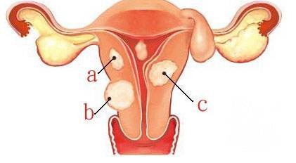 苏州妇科_预防子宫肌瘤要少吃哪些食物