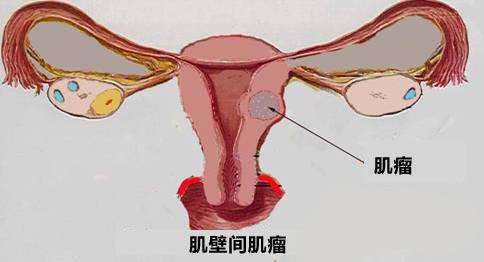 苏州哪的妇科病医院好_子宫肌瘤有哪些症状