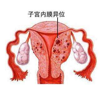 苏州妇科有什么好医院_子宫内膜异位的症状