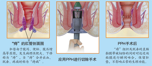 PPH治疗