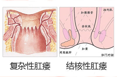 肛瘘 治疗 肛瘘的首选治疗方法是什么