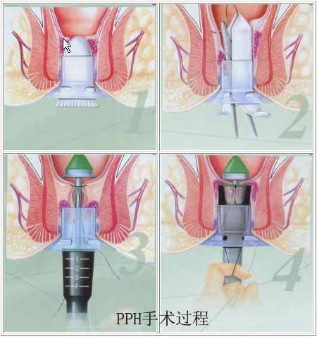 PPH治疗痔疮示意图