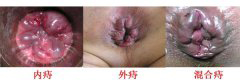 痔疮