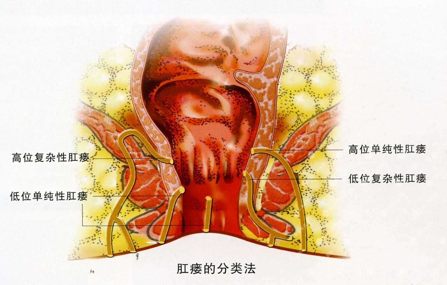 肛瘘如何分类