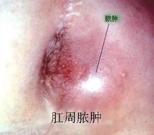 肛周脓肿