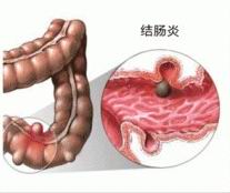 结肠炎