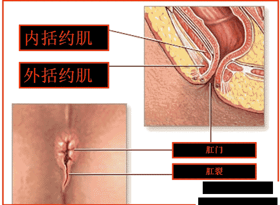 肛裂