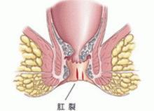 肛裂