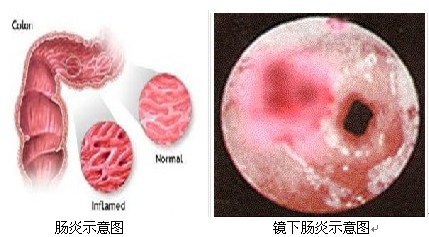 结肠炎